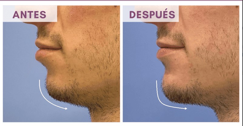 Mentoplastia caso 5 — antes y después